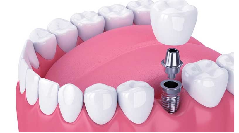 Dentist Supports